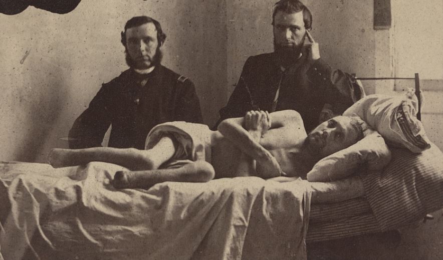 Corporal Calvin Bates of Co. E, 20th Maine Infantry Regiment, after inhumane treatment at Andersonville Prison resulting in the decay and amputation of his feet